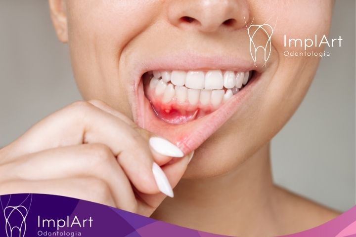 Afta na Boca: Causas Comuns e Tratamentos Eficazes afta na boca