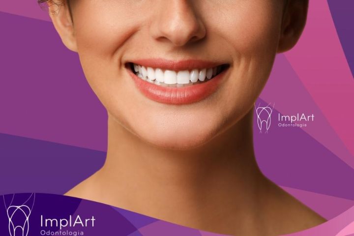 Como é feito um Implante Dentário na Clínica ImplArt: Conheça o passo a passo do implante etapas do implante dentário