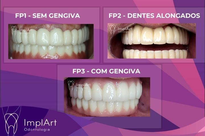 Prótese Protocolo Sem Gengiva ou Protocolo Com Gengiva? Entenda as Diferenças para seu Tratamento com Implante Total prótese protocolo sem gengiva