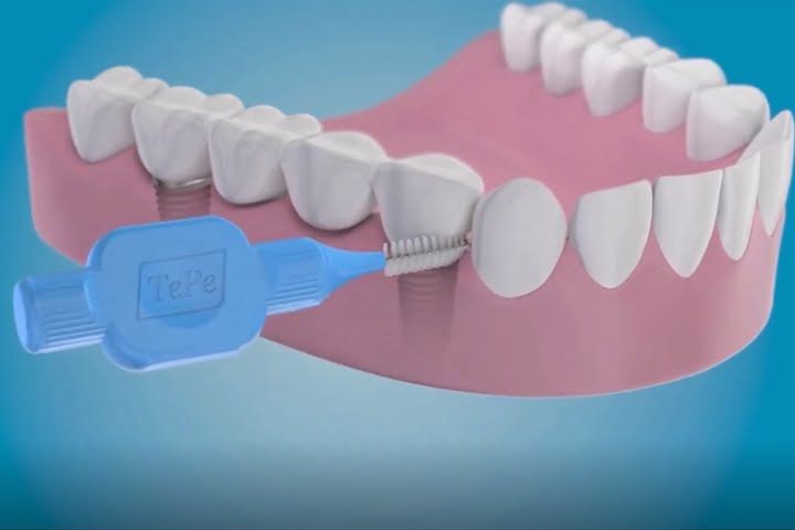 Escova interdental para manutenção de implantes dentarios escova interdental