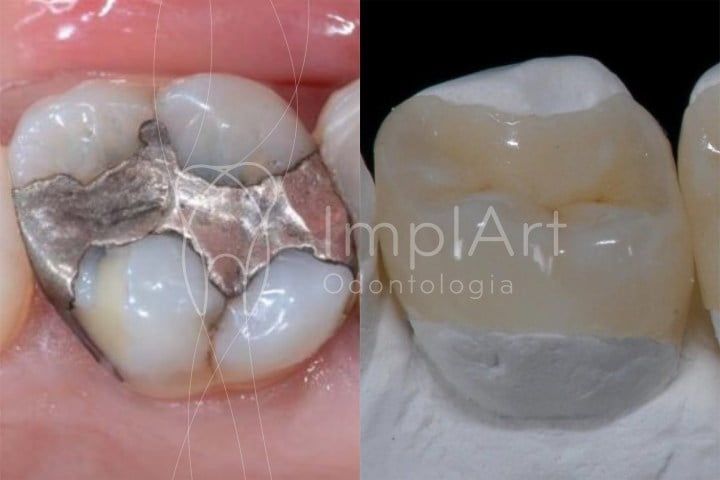 Restaurações dentárias: quando é preciso troca-las? restaurações dentárias