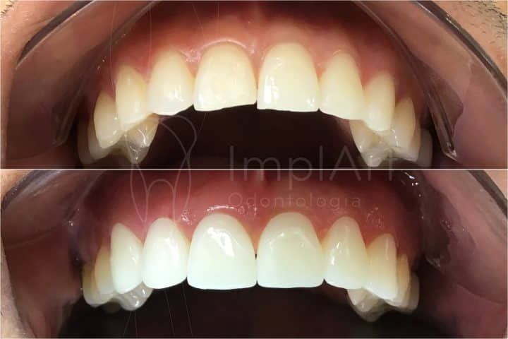 Lente dental antes e depois lente dental