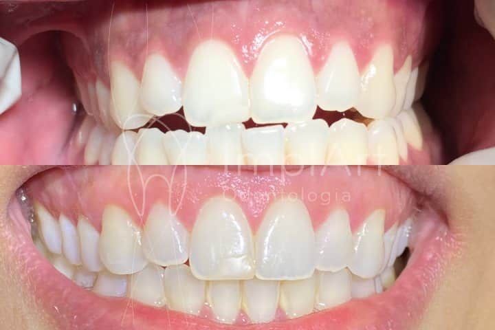Clareamento gengival e Invisalign antes e depois Clareamento gengival