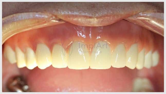 Prótese fixa de porcelana sobre dentes com ou sem gengiva Prótese fixa de porcelana