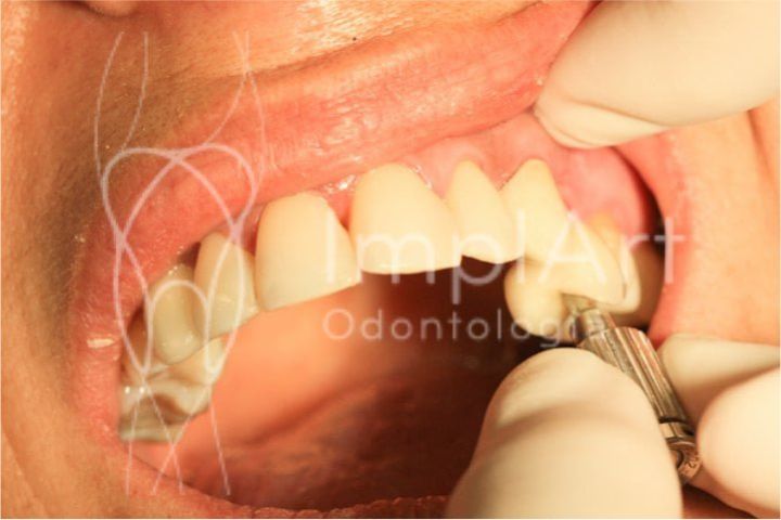 Posso extrair um dente e colocar prótese no mesmo dia? extrair um dente