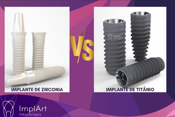 Implante de Titânio ou Implante de Zircônia: Qual o Melhor Material para Implantes Dentários? QUAL MELHOR IMPLANTE