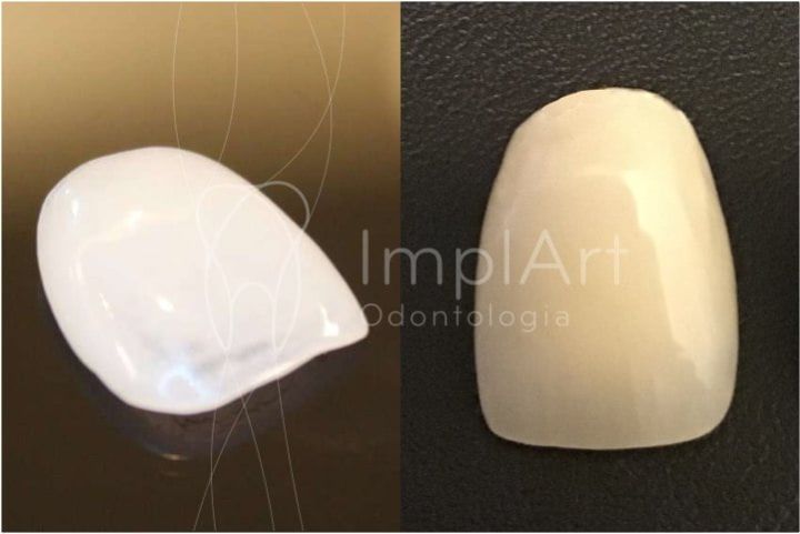 Diferenças entre preparo para lente de contato dental e coroa dentária preparo