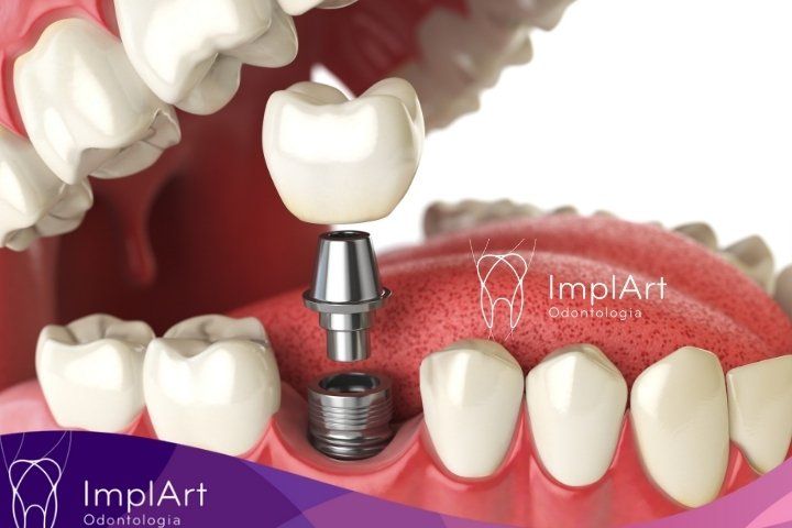 Implantes imediatos - implante dentário rápido logo após a extração do dente IMPLANTES IMEDIATOS