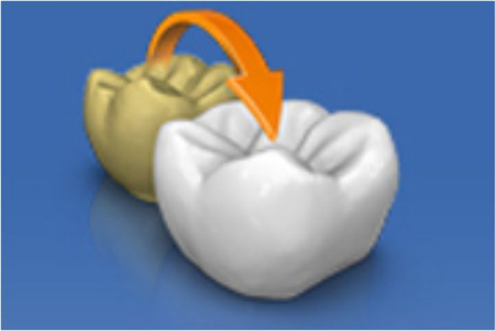 Cerec 3D - novos dentes com preservação de formatos cerec 3D