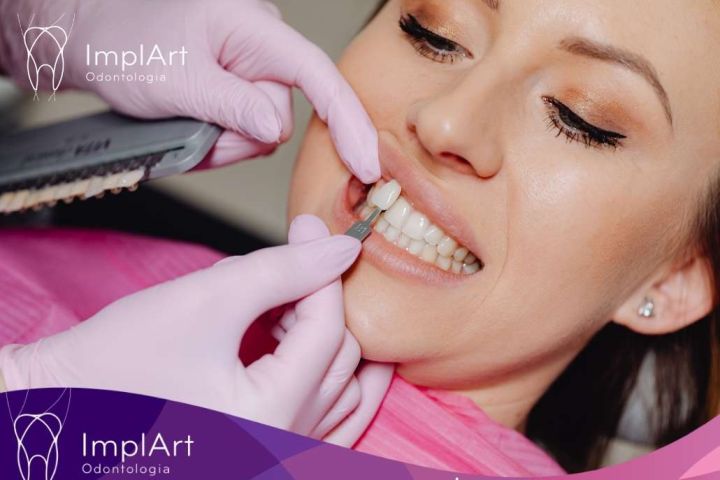 The Dangers of the Resin Veneer Trend in Young People composite veneers are not good