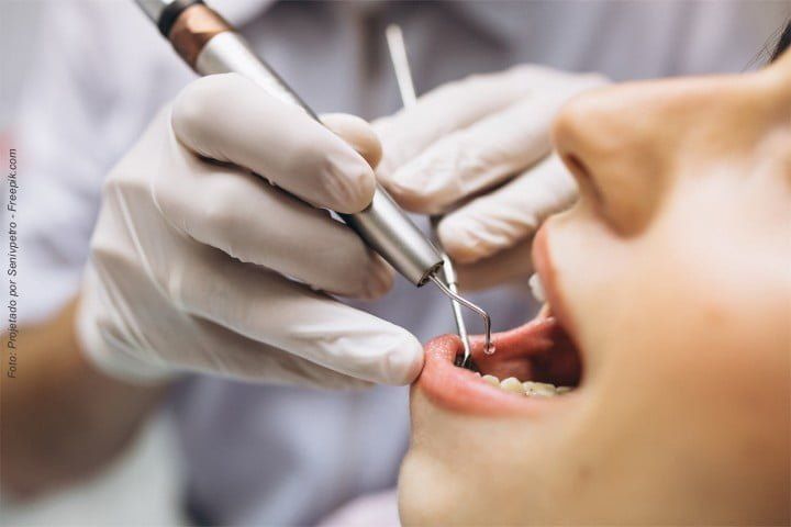 A importância da limpeza profissional para manutenção de implantes dentarios, próteses dentárias e da saúde bucal limpeza profissional