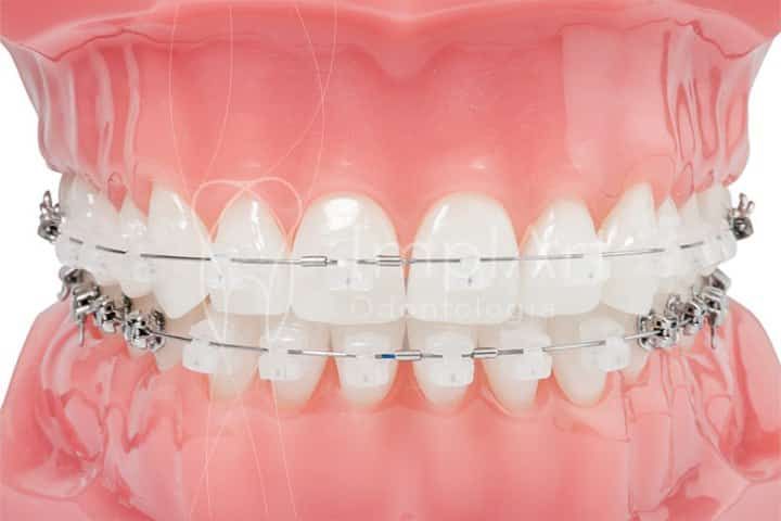 Self-ligating braces - speed and comfort Self-ligating braces