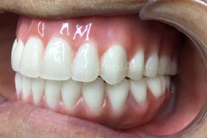 Dental Implants for Dentures - Acrylic Bridge Dental Implants for Dentures