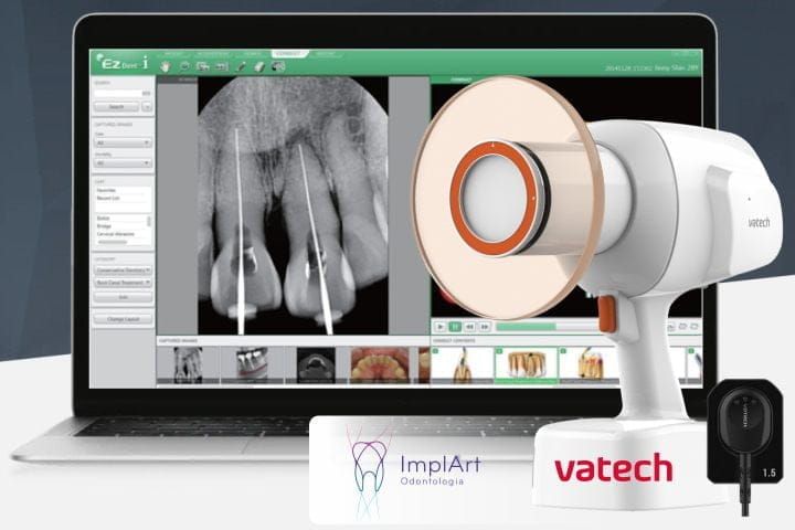 Radiografia Periapical Digital na ImplArt radiografia periapical digital