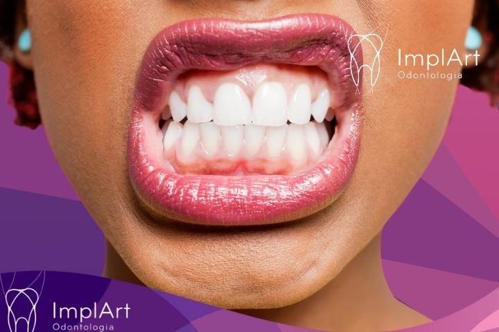 Bruxism and Dental Clenching: Understanding the Causes, Symptoms and Treatments According to Dr. Roberto Markarian bruxism and clenching