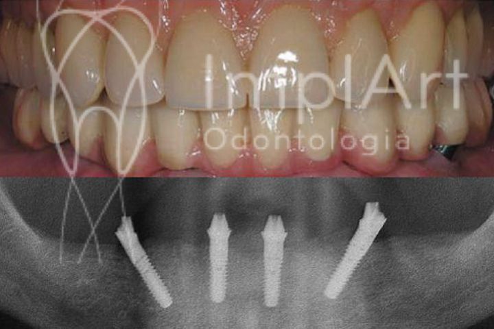 8 erros comuns a evitar ao fazer Implantes Dentários All on Four implantes dentarios all on four