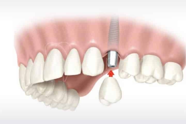 Carga rápida (imediata) em implantes dentários carga rápida