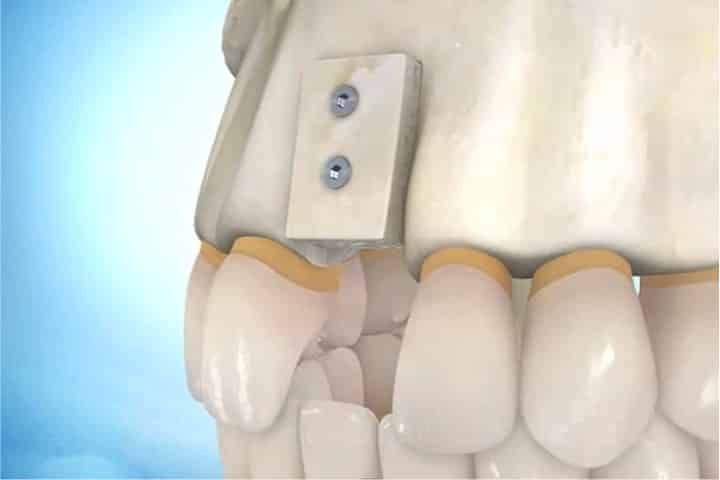 Alternatives to dental bone grafting enxerto em bloco