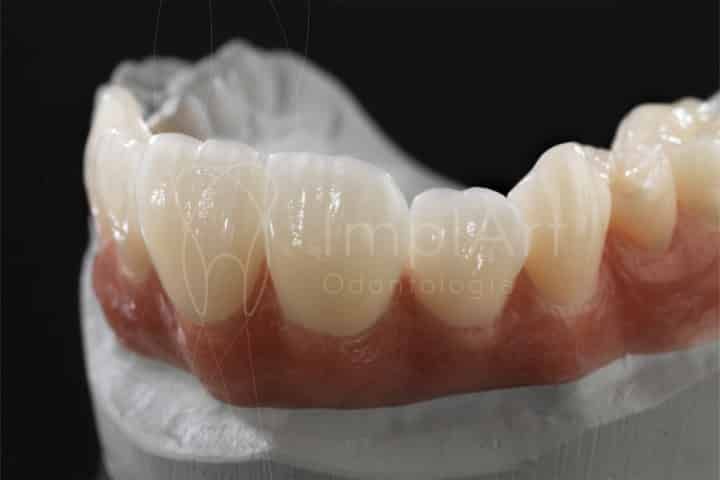 Prótese fixa sobre dentes pode ser substituída por coroas e implantes prótese dental