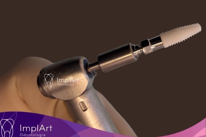 Implante Dentário de Zircônia: A Solução Estética e Biocompatível para Substituição de Dentes implante de zirconia