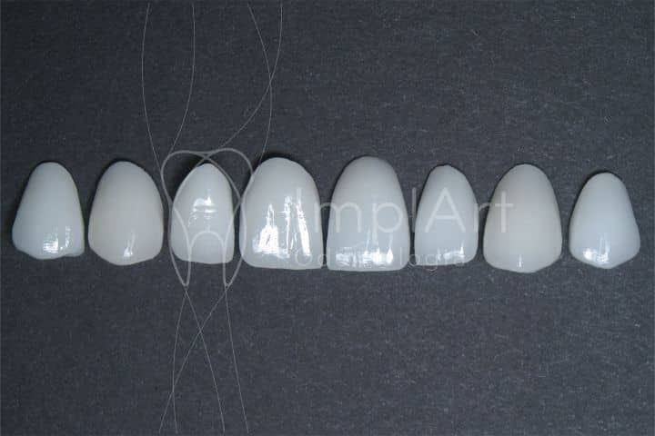 Lentes dentais sobre implante ou prótese: é possível? lentes dentais