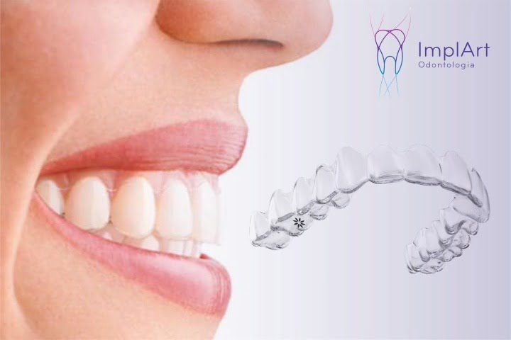 Alinhadores transparentes ImplArt (Aligners) alinhadores transparentes