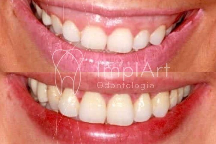 Cirurgia de aumento de coroa clínica coroa clínica