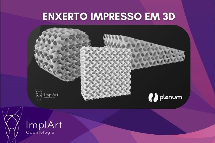 Enxerto Ósseo 3D sob medida: Enxerto Impresso em 3D para casos complexos de implante dentário enxerto ósseo 3d customizado