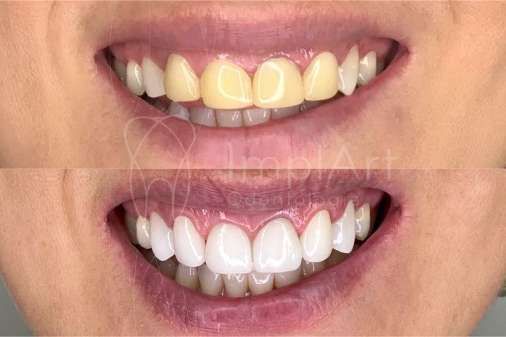 Contact lenses for teeth Lentes de Contato