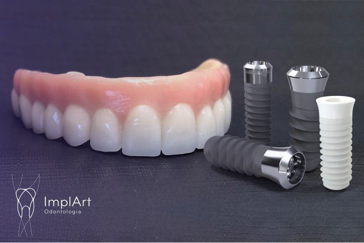 Dental Implants at ImplArt Dental Clinic Specializing in Dental Implants specialist