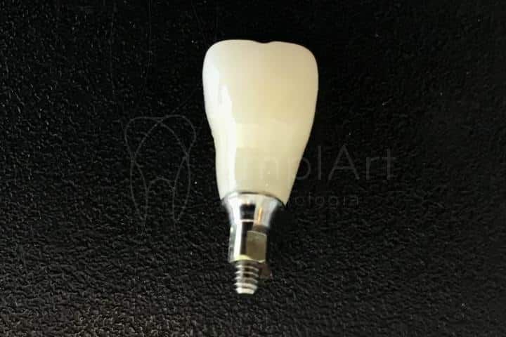 Porcelain crown for implants - Day Clinic porcelain implant crown