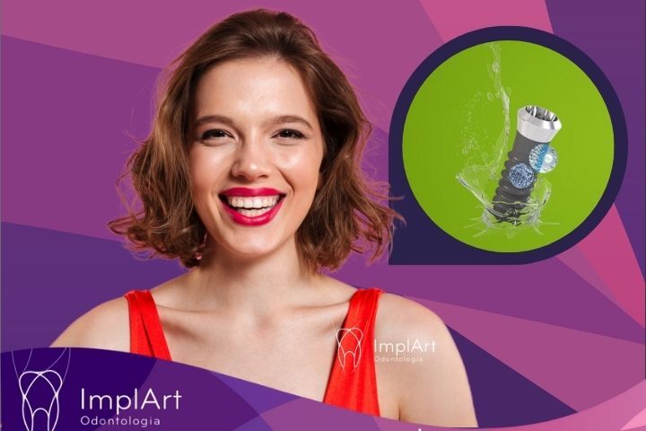 Valor do Implante dentario: Como saber o preço do implante dentário? valor do implante dentario