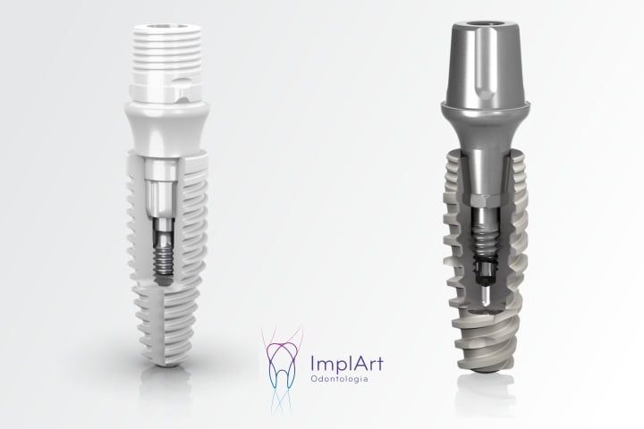 Qual a diferença entre implante cerâmico e o implante dentario de titânio? implante cerâmico