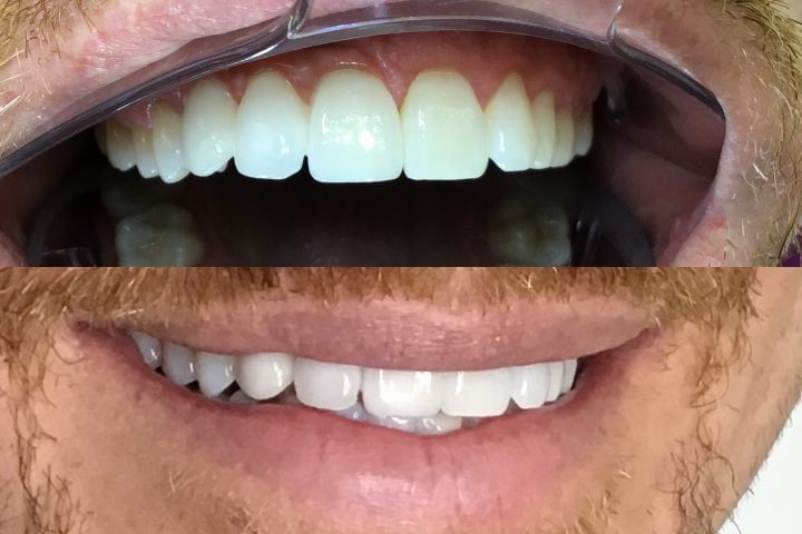 Prótese dentária fixa com gengiva artificial - Foto prótese dentária fixa