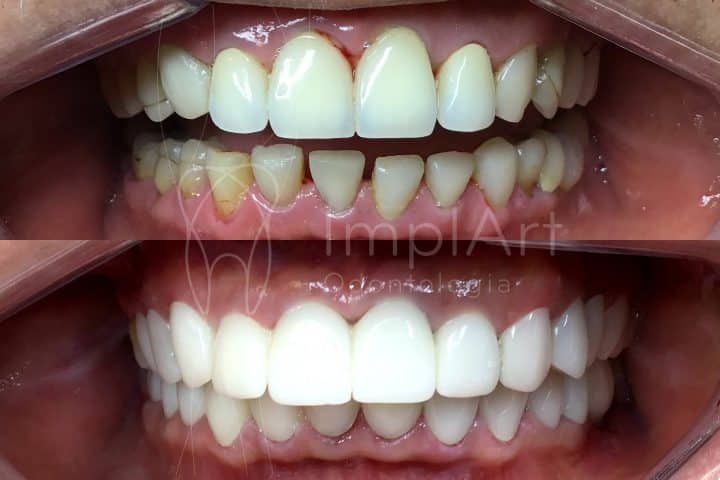 Lentes de contato dental antes e depois Lentes de contato dental