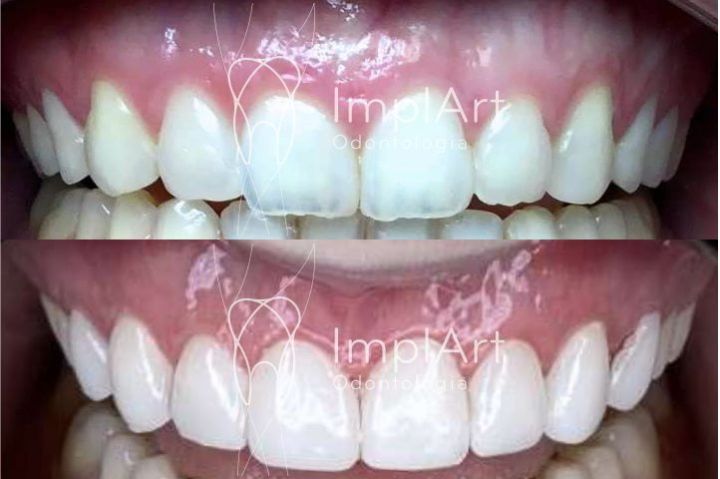 Lentes dentais - Clínica especialista lentes dentais