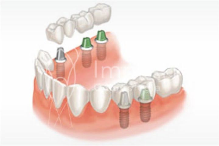 Falta de dentes do fundo causa problemas na mastigação Falta de dentes