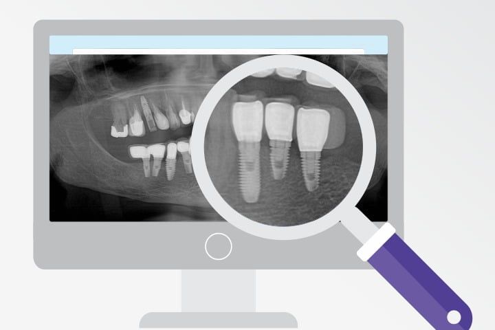 Identificação de implantes dentários: é possível descobrir qual é 1 tipo? Identificação de implantes