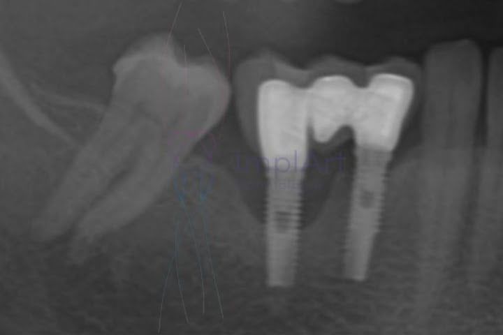 Implantes podem pegar doença periodontal? doença periodontal