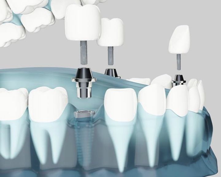 Implante de vários dentes da boca ao mesmo tempo implante de varios dentes