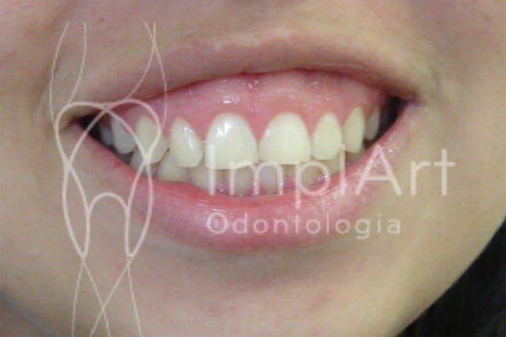 Aspecto do sorriso gengival sorriso gengival