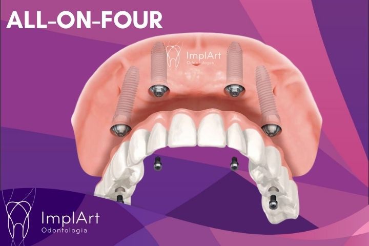 Técnica de implantes All on four ou All on 4: Prótese Protocolo aLL-ON-FOUR