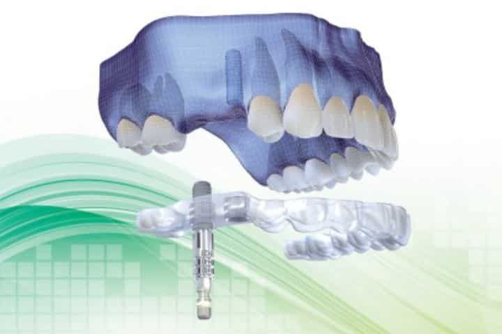 Implante dentário sem corte e cirurgia guiada por computador Implante dentário sem cortes