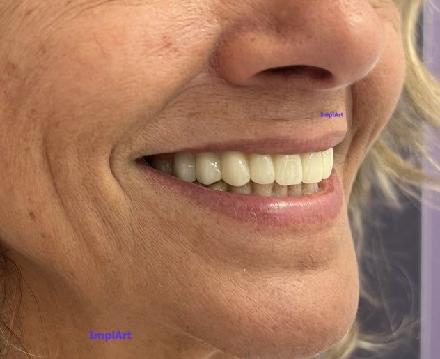 Full Arch Implants: What is it, how is it done, how does it work? protocolo dentario como é feito