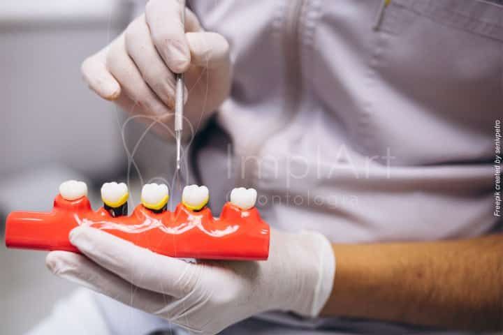 O que é raspagem periodontal e para que serve? raspagem