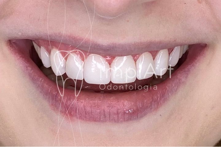 Porcelain dental contact porcelain lenses Dental contact lenses