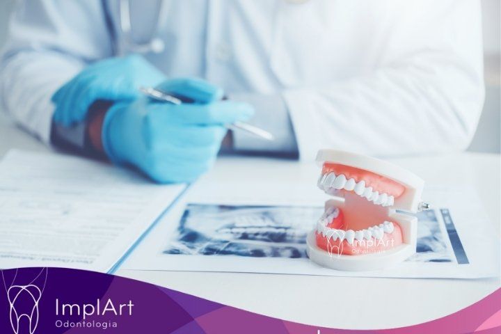 Especialistas em Corrigir Implante Dentário Mal Feito em São Paulo implante dentario mal feito