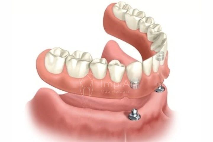 Prótese móvel para implantes - Overdenture overdenture
