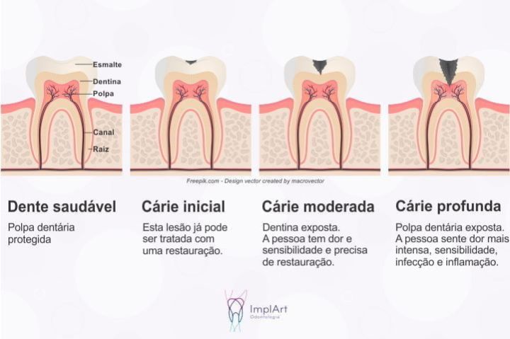 Comprometimento dental pela cárie: fases e tratamentos cárie