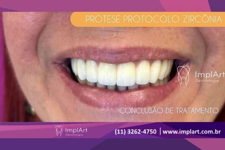 Zircônia Monolítica: Inovação em Prótese Fixa na Clínica ImplArt ZIRCONIA MONOLÍTICA